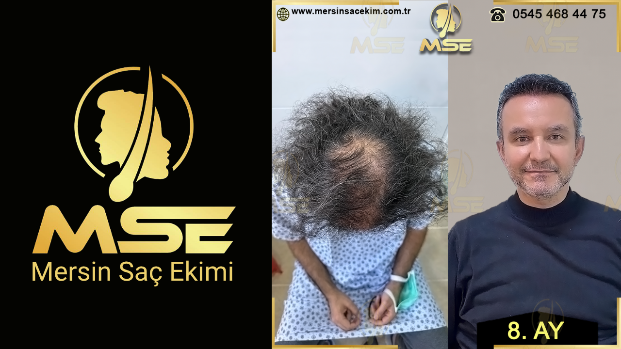 MERSİN SAÇ EKİMİ